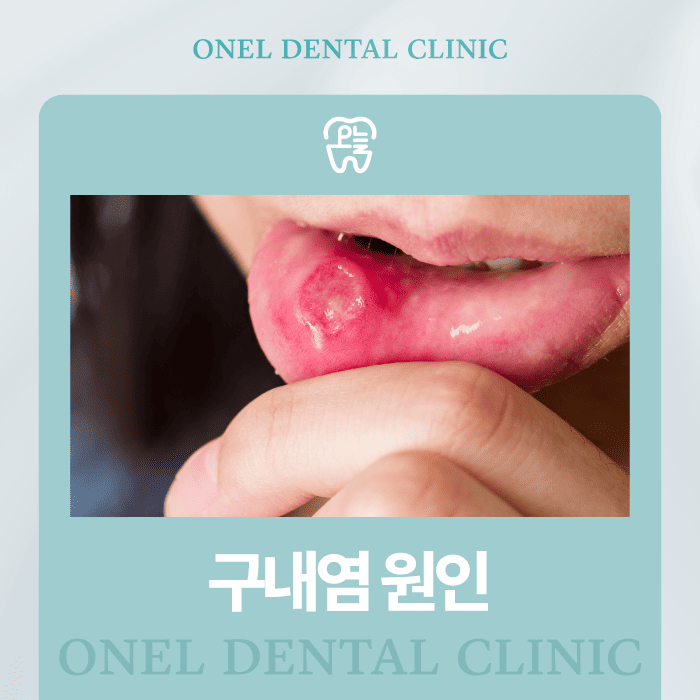 하양읍치과 구내염, 잇몸염증 차이